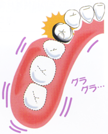 当医院の入れ歯（義歯）について